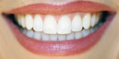 dentures - smile - teeth