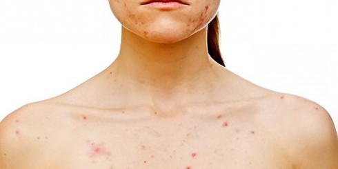 acne-bacteria