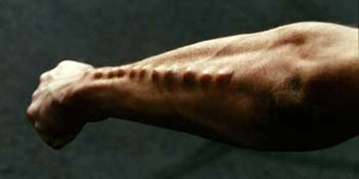 body-implants-arm