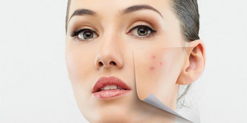 acne face girl skin