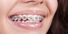 Girl teeth in braces