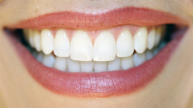 dentures - smile - teeth