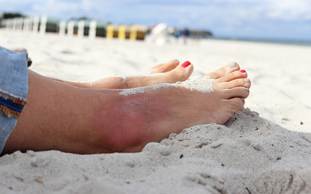 sprained ankle sports injuries